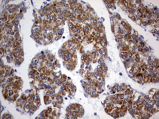 OXSM / KS Antibody - IHC of paraffin-embedded Carcinoma of Human liver tissue using anti-OXSM mouse monoclonal antibody. (Heat-induced epitope retrieval by 1 mM EDTA in 10mM Tris, pH9.0, 120°C for 3min).