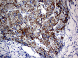 OXSM / KS Antibody - IHC of paraffin-embedded Carcinoma of Human liver tissue using anti-OXSM mouse monoclonal antibody.