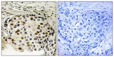 OXSR1 / OSR1 Antibody - Immunohistochemistry analysis of paraffin-embedded human breast carcinoma, using OSR1 (Phospho-Thr185) Antibody. The picture on the right is blocked with the phospho peptide.