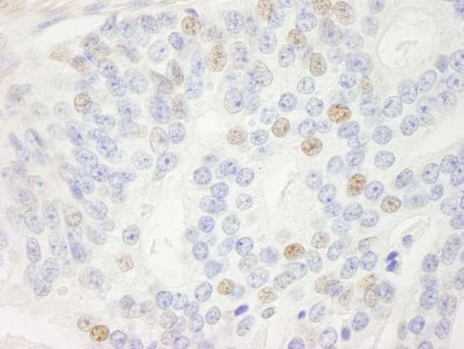 p14ARF / CDKN2A Antibody - Detection of Human p14ARF by Immunohistochemistry. Sample: FFPE section of human prostate adenocarcinoma. Antibody: Affinity purified rabbit anti-p14ARF used at a dilution of 1:250.