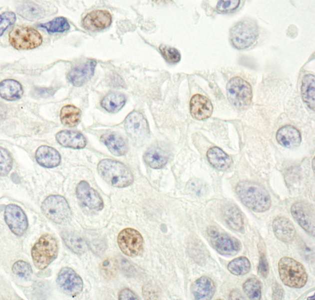 p14ARF / CDKN2A Antibody - Detection of Human p14ARF by Immunohistochemistry. Sample: FFPE section of human prostate carcinoma. Antibody: Affinity purified rabbit anti-p14ARF used at a dilution of 1:1000 (1 ug/ml). Detection: DAB.