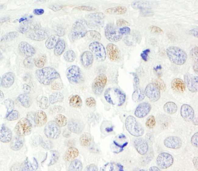 p14ARF / CDKN2A Antibody - Detection of Human p14ARF by Immunohistochemistry. Sample: FFPE section of human prostate carcinoma. Antibody: Affinity purified rabbit anti-p14ARF used at a dilution of 1:1000 (1 ug/ml). Detection: DAB.