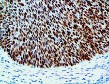 p14ARF / CDKN2A Antibody - IHC of p14 ARF on an FFPE Anal Carcinoma Tissue