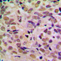 p14ARF / CDKN2A Antibody - Immunohistochemical analysis of p14 ARF staining in human breast cancer formalin fixed paraffin embedded tissue section. The section was pre-treated using heat mediated antigen retrieval with sodium citrate buffer (pH 6.0). The section was then incubated with the antibody at room temperature and detected using an HRP conjugated compact polymer system. DAB was used as the chromogen. The section was then counterstained with hematoxylin and mounted with DPX.