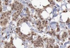 p14ARF / CDKN2A Antibody - 1:200 staining human breast carcinoma tissue by IHC-P. The tissue was formaldehyde fixed and a heat mediated antigen retrieval step in citrate buffer was performed. The tissue was then blocked and incubated with the antibody for 1.5 hours at 22°C. An HRP conjugated goat anti-rabbit antibody was used as the secondary.