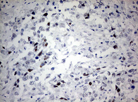 p16INK4a / CDKN2A Antibody - IHC of paraffin-embedded Adenocarcinoma of Human ovary tissue using anti-CDKN2A mouse monoclonal antibody. (Heat-induced epitope retrieval by 10mM citric buffer, pH6.0, 120°C for 3min).