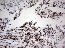 p16INK4a / CDKN2A Antibody - IHC of paraffin-embedded Adenocarcinoma of Human endometrium tissue using anti-CDKN2A mouse monoclonal antibody. (Heat-induced epitope retrieval by 10mM citric buffer, pH6.0, 120°C for 3min).