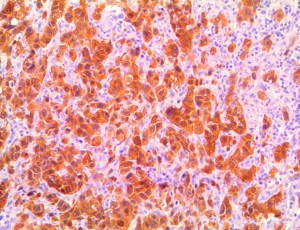 p16INK4a / CDKN2A Antibody - IHC of p16 on an FFPE Mucoepidermoid Carcinoma Tissue