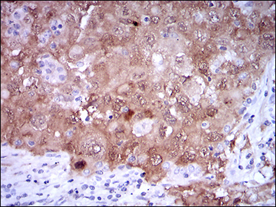 p16INK4a / CDKN2A Antibody - IHC of paraffin-embedded lung cancer tissues using CDKN2A mouse monoclonal antibody with DAB staining.