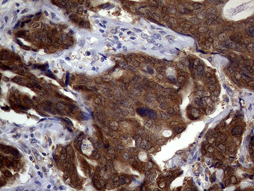 p16INK4a / CDKN2A Antibody - Immunohistochemical staining of paraffin-embedded Adenocarcinoma of Human breast tissue tissue using anti-CDKN2A mouse monoclonal antibody. (Heat-induced epitope retrieval by 1mM EDTA in 10mM Tris buffer. (pH8.5) at 120°C for 3 min. (1:2000)