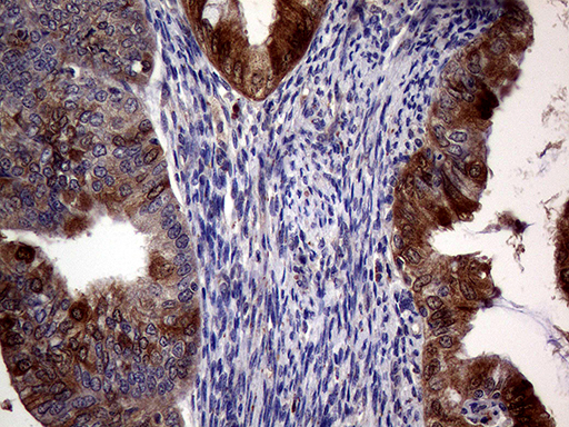 p16INK4a / CDKN2A Antibody - Immunohistochemical staining of paraffin-embedded Adenocarcinoma of Human endometrium tissue using anti-CDKN2A mouse monoclonal antibody. (Heat-induced epitope retrieval by 1mM EDTA in 10mM Tris buffer. (pH8.5) at 120°C for 3 min. (1:2000)