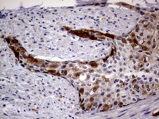 p16INK4a / CDKN2A Antibody - Immunohistochemical staining of paraffin-embedded Carcinoma of Human bladder tissue using anti-CDKN2A mouse monoclonal antibody. (Heat-induced epitope retrieval by 1mM EDTA in 10mM Tris buffer. (pH8.5) at 120°C for 3 min. (1:2000)