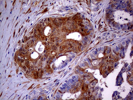 p16INK4a / CDKN2A Antibody - Immunohistochemical staining of paraffin-embedded Adenocarcinoma of Human ovary tissue using anti-CDKN2A mouse monoclonal antibody. (Heat-induced epitope retrieval by 1mM EDTA in 10mM Tris buffer. (pH8.5) at 120°C for 3 min. (1:500)