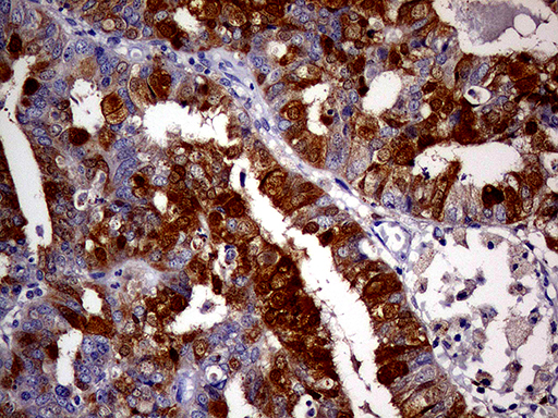 p16INK4a / CDKN2A Antibody - Immunohistochemical staining of paraffin-embedded Adenocarcinoma of Human endometrium tissue using anti-CDKN2A mouse monoclonal antibody. (Heat-induced epitope retrieval by 1mM EDTA in 10mM Tris buffer. (pH8.5) at 120°C for 3 min. (1:500)