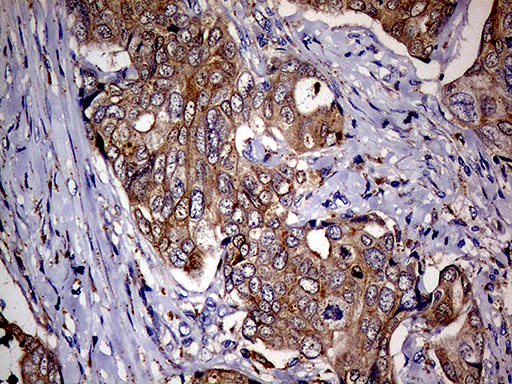 p16INK4a / CDKN2A Antibody - Immunohistochemical staining of paraffin-embedded Adenocarcinoma of Human breast tissue tissue using anti-CDKN2A mouse monoclonal antibody. (Heat-induced epitope retrieval by 1mM EDTA in 10mM Tris buffer. (pH8.5) at 120°C for 3 min. (1:500)