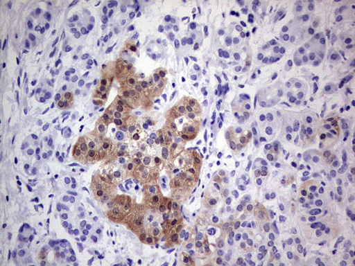 p16INK4a / CDKN2A Antibody - Immunohistochemical staining of paraffin-embedded Carcinoma of Human pancreas tissue using anti-CDKN2A mouse monoclonal antibody. (Heat-induced epitope retrieval by 1 mM EDTA in 10mM Tris, pH8.5, 120C for 3min,