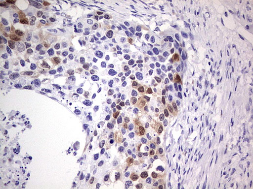 p16INK4a / CDKN2A Antibody - Immunohistochemical staining of paraffin-embedded Carcinoma of Human kidney tissue using anti-CDKN2A mouse monoclonal antibody. (Heat-induced epitope retrieval by 1 mM EDTA in 10mM Tris, pH8.5, 120C for 3min,