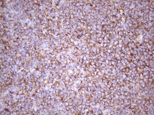 p16INK4a / CDKN2A Antibody - Immunohistochemical staining of paraffin-embedded Human lymphoma tissue using anti-CDKN2A mouse monoclonal antibody. (Heat-induced epitope retrieval by Tris-EDTA, pH8.0)(1:150)