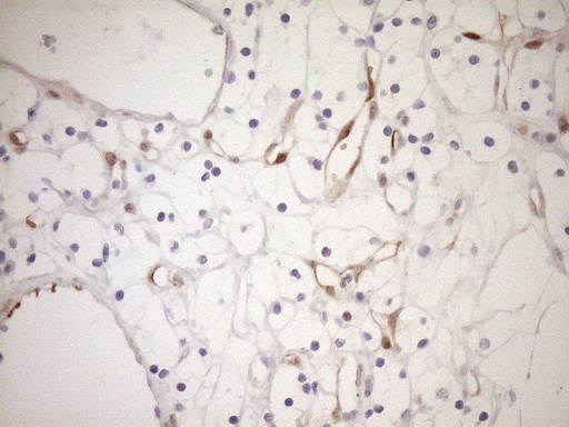 p16INK4a / CDKN2A Antibody - Immunohistochemical staining of paraffin-embedded Carcinoma of Human kidney tissue using anti-CDKN2A mouse monoclonal antibody. (Heat-induced epitope retrieval by 1mM EDTA in 10mM Tris buffer. (pH8.5) at 120°C for 3 min. (1:150)