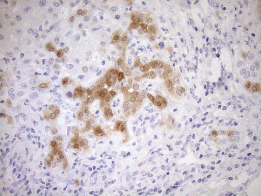 p16INK4a / CDKN2A Antibody - Immunohistochemical staining of paraffin-embedded Carcinoma of Human liver tissue using anti-CDKN2A mouse monoclonal antibody. (Heat-induced epitope retrieval by 1mM EDTA in 10mM Tris buffer. (pH8.5) at 120°C for 3 min. (1:150)