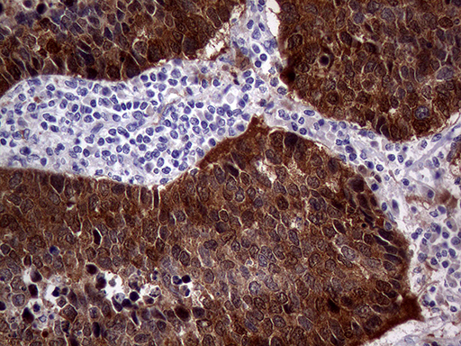 p16INK4a / CDKN2A Antibody - Immunohistochemical staining of paraffin-embedded Carcinoma of Human lung tissue using anti-CDKN2A mouse monoclonal antibody. (Heat-induced epitope retrieval by 1mM EDTA in 10mM Tris buffer. (pH8.5) at 120°C for 3 min. (1:2000)