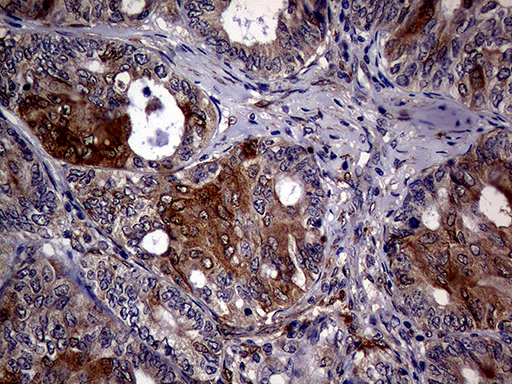 p16INK4a / CDKN2A Antibody - Immunohistochemical staining of paraffin-embedded Adenocarcinoma of Human ovary tissue using anti-CDKN2A mouse monoclonal antibody. (Heat-induced epitope retrieval by 1mM EDTA in 10mM Tris buffer. (pH8.5) at 120°C for 3 min. (1:2000)