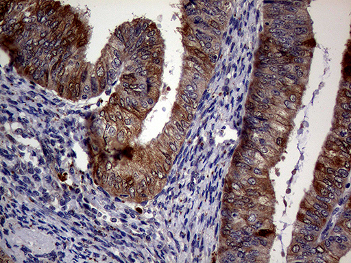 p16INK4a / CDKN2A Antibody - Immunohistochemical staining of paraffin-embedded Adenocarcinoma of Human endometrium tissue using anti-CDKN2A mouse monoclonal antibody. (Heat-induced epitope retrieval by 1mM EDTA in 10mM Tris buffer. (pH8.5) at 120°C for 3 min. (1:2000)