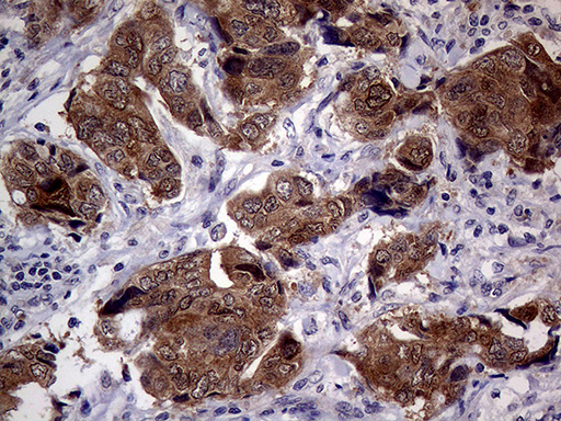 p16INK4a / CDKN2A Antibody - Immunohistochemical staining of paraffin-embedded Adenocarcinoma of Human breast tissue tissue using anti-CDKN2A mouse monoclonal antibody. (Heat-induced epitope retrieval by 1mM EDTA in 10mM Tris buffer. (pH8.5) at 120°C for 3 min. (1:2000)