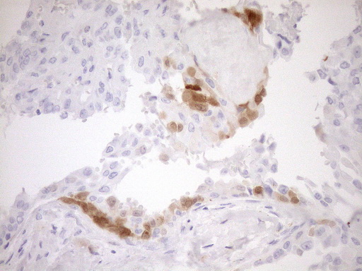p16INK4a / CDKN2A Antibody - Immunohistochemical staining of paraffin-embedded Carcinoma of Human thyroid tissue using anti-CDKN2A mouse monoclonal antibody. (Heat-induced epitope retrieval by 1mM EDTA in 10mM Tris buffer. (pH8.5) at 120°C for 3 min. (1:150)