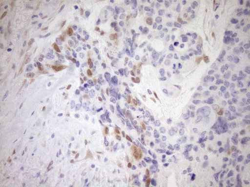 p16INK4a / CDKN2A Antibody - Immunohistochemical staining of paraffin-embedded Adenocarcinoma of Human endometrium tissue using anti-CDKN2A mouse monoclonal antibody. (Heat-induced epitope retrieval by 1mM EDTA in 10mM Tris buffer. (pH8.5) at 120°C for 3 min. (1:150)