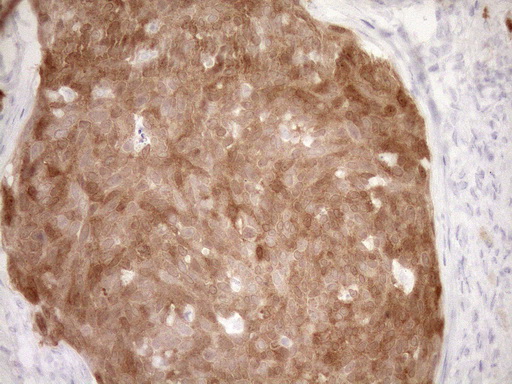 p16INK4a / CDKN2A Antibody - Immunohistochemical staining of paraffin-embedded Carcinoma of Human Cervix Uterus using anti-CDKN2A mouse monoclonal antibody. (Heat-induced epitope retrieval by Tris-EDTA(1:150)