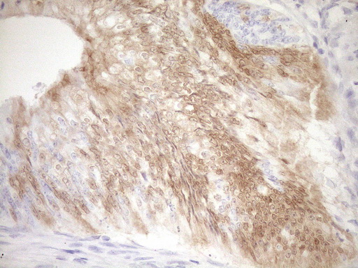 p16INK4a / CDKN2A Antibody - Immunohistochemical staining of paraffin-embedded Adenocarcinoma of Human colon tissue using anti-CDKN2A mouse monoclonal antibody. (Heat-induced epitope retrieval by 1mM EDTA in 10mM Tris buffer. (pH8.5) at 120°C for 3 min. (1:150)