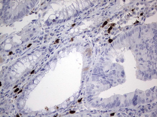 p16INK4a / CDKN2A Antibody - IHC of paraffin-embedded Adenocarcinoma of Human colon tissue using anti-CDKN2A mouse monoclonal antibody. (Heat-induced epitope retrieval by 1 mM EDTA in 10mM Tris, pH8.5, 120°C for 3min).