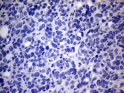 p16INK4a / CDKN2A Antibody - Immunohistochemical staining of paraffin-embedded Carcinoma of Human thyroid tissue using anti-CDKN2A mouse monoclonal antibody.This figure shows negative staining. (Heat-induced epitope retrieval by 1mM EDTA in 10mM Tris buffer. (pH8.5) at 120°C for 3 min(1:150).