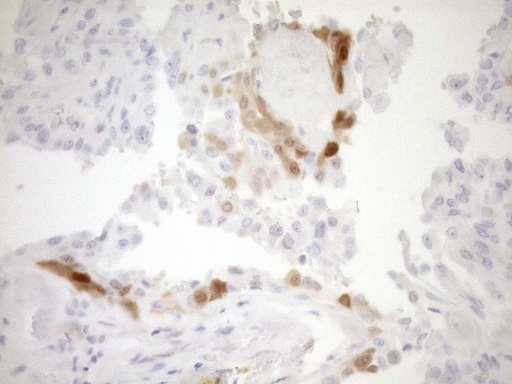 p16INK4a / CDKN2A Antibody - Immunohistochemical staining of paraffin-embedded Carcinoma of Human thyroid tissue using anti-CDKN2A mouse monoclonal antibody. (Heat-induced epitope retrieval by 1mM EDTA in 10mM Tris buffer. (pH8.5) at 120°C for 3 min. (1:150)
