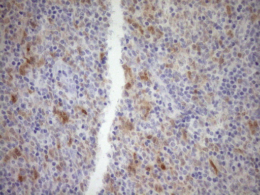 p16INK4a / CDKN2A Antibody - Immunohistochemical staining of paraffin-embedded Human lymphoma tissue using anti-CDKN2A mouse monoclonal antibody. (Heat-induced epitope retrieval by 1mM EDTA in 10mM Tris buffer. (pH8.5) at 120°C for 3 min. (1:150)