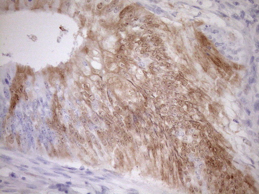 p16INK4a / CDKN2A Antibody - Immunohistochemical staining of paraffin-embedded Adenocarcinoma of Human colon tissue using anti-CDKN2A mouse monoclonal antibody. (Heat-induced epitope retrieval by 1mM EDTA in 10mM Tris buffer. (pH8.5) at 120°C for 3 min. (1:150)