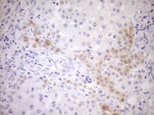 p16INK4a / CDKN2A Antibody - Immunohistochemical staining of paraffin-embedded Carcinoma of Human liver tissue using anti-CDKN2A mouse monoclonal antibody. (Heat-induced epitope retrieval by 1mM EDTA in 10mM Tris buffer. (pH8.5) at 120°C for 3 min. (1:150)