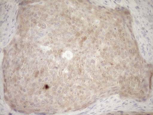 p16INK4a / CDKN2A Antibody - Immunohistochemical staining of paraffin-embedded Carcinoma of Human Cervix Uterus using anti-CDKN2A mouse monoclonal antibody. (Heat-induced epitope retrieval by Tris-EDTA(1:150)