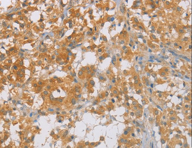 p16INK4a / CDKN2A Antibody - Immunohistochemistry of paraffin-embedded Human thyroid cancer using CDKN2A Polyclonal Antibody at dilution of 1:60.