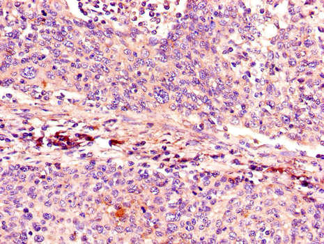 p16INK4a / CDKN2A Antibody - Immunohistochemistry of paraffin-embedded human cervical cancer using CDKN2A Antibody at dilution of 1:100