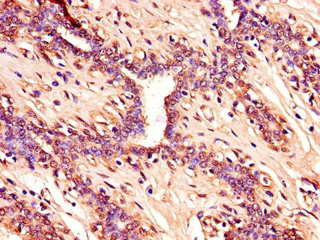 p16INK4a / CDKN2A Antibody - Immunohistochemistry of paraffin-embedded human breast cancer using CDKN2A Antibody at dilution of 1:100