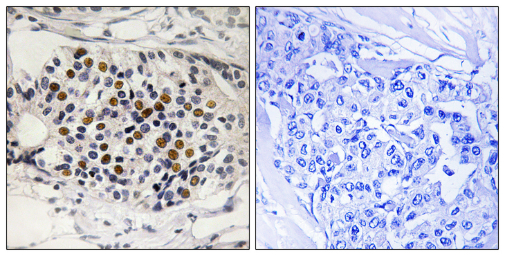 p16INK4a / CDKN2A Antibody - Immunohistochemistry analysis of paraffin-embedded human breast carcinoma, using p16-INK4a (Phospho-Ser152) Antibody. The picture on the right is blocked with the phospho peptide.