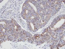p21-ARC / ARPC3 Antibody - IHC of paraffin-embedded endo mitral OVCA using ARPC3 antibody at 1:100 dilution.
