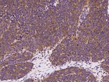 p21-ARC / ARPC3 Antibody - Immunochemical staining of human ARPC3 in human ovarian cancer with rabbit polyclonal antibody at 1:1000 dilution, formalin-fixed paraffin embedded sections.