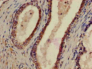 P2RX1 / P2X1 Antibody - Immunohistochemistry of paraffin-embedded human prostate cancer using P2RX1 Antibody at dilution of 1:100