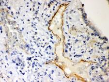 P2RX2 / P2X2 Antibody - P2X2 antibody IHC-paraffin: Human Lung Cancer Tissue.