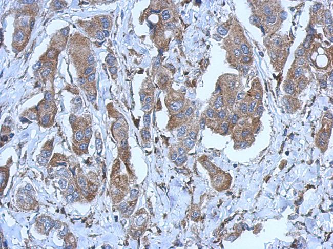 P2RX2 / P2X2 Antibody - IHC of paraffin-embedded Breast ca, using P2X2 antibody at 1:500 dilution.