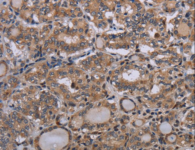 P2RX2 / P2X2 Antibody - Immunohistochemistry of paraffin-embedded Human thyroid cancer using P2RX2 Polyclonal Antibody at dilution of 1:50.