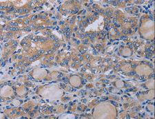 P2RX3 / P2X3 Antibody - Immunohistochemistry of paraffin-embedded Human thyroid cancer using P2RX3 Polyclonal Antibody at dilution of 1:50.